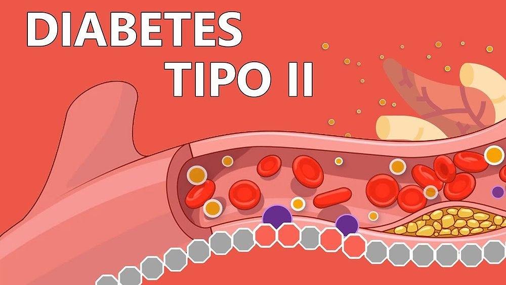 Diabetes tipo 2