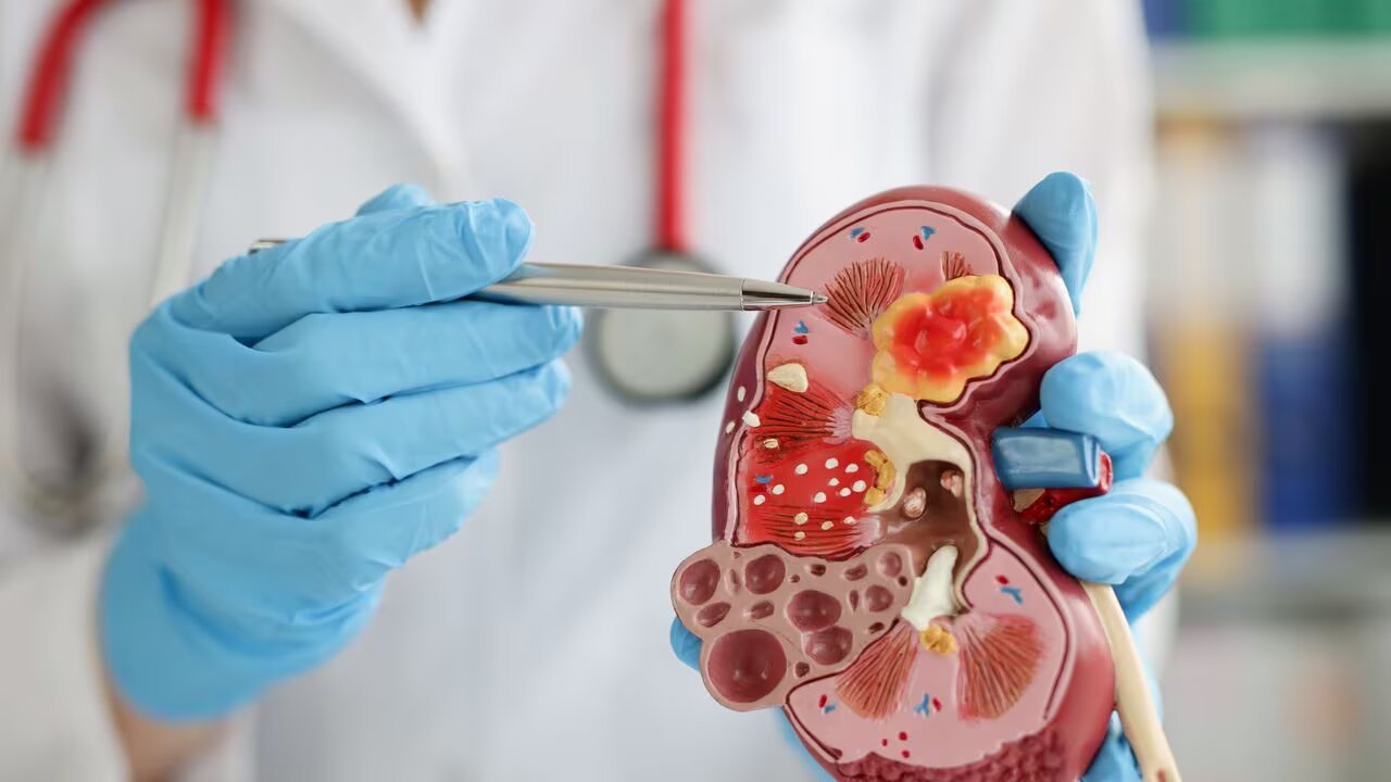 La enfermedad renal crónica es pandemia en el país y en el mundo